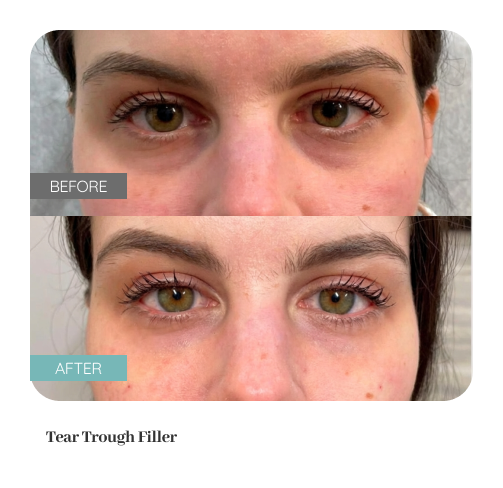 Before and after treatment result — Dr. Lanna, LC Medical Aesthetics NYC